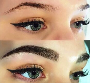 Brow lift